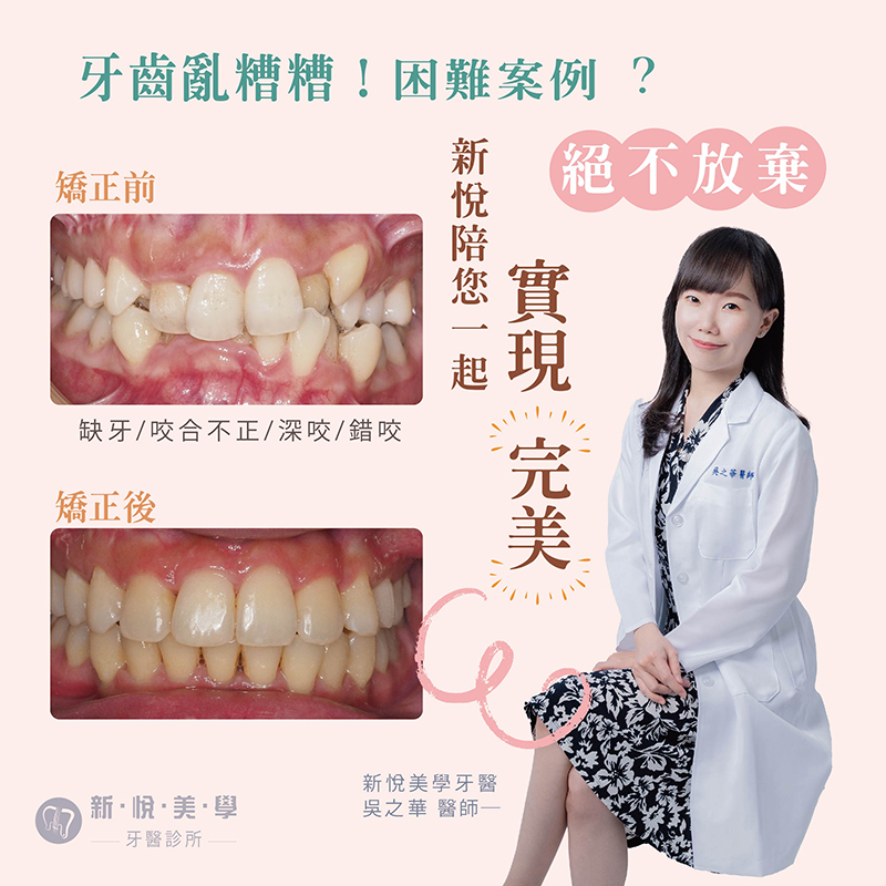 牙齒亂糟糟 ! 困難案例 !新悅不放棄的第1張圖片